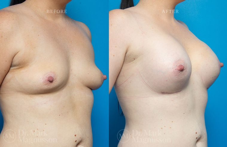 Breast Asymmetry Correction and Breast Implants (Augmentation) BA 005
