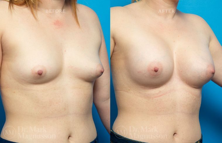 Breast Asymmetry Correction and Breast Implants (Augmentation) BA 007