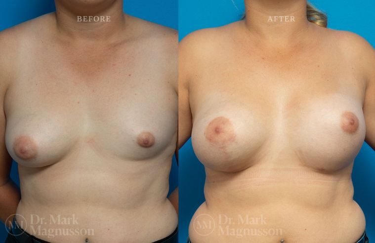 Breast Asymmetry Correction, Breast Implants, and Mastopexy BA 005