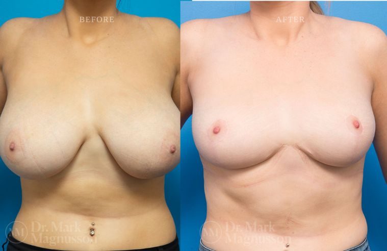 Breast Asymmetry Correction and Breast Reduction BA 002