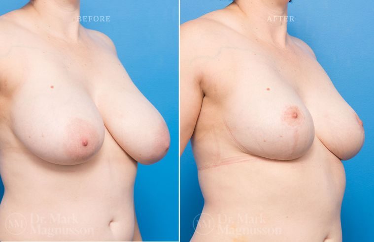 Breast Asymmetry Correction and Breast Reduction BA 004