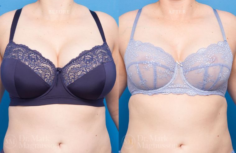 Breast Asymmetry Correction and Breast Reduction BA 005