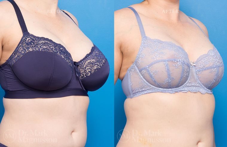 Breast Asymmetry Correction and Breast Reduction BA 006