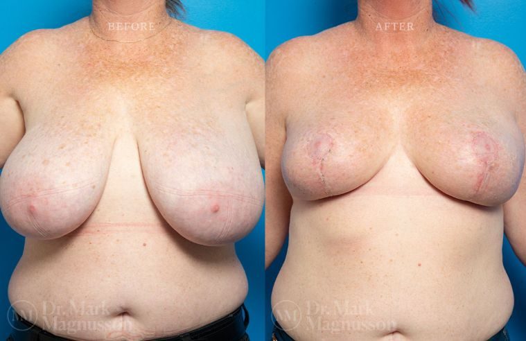 Breast Asymmetry Correction and Breast Reduction BA 007