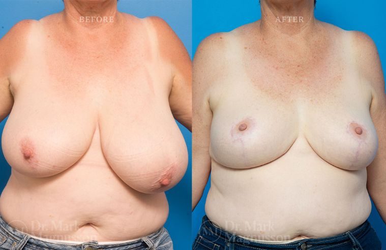 Breast Asymmetry Correction and Reduction Mammoplasty BA 009