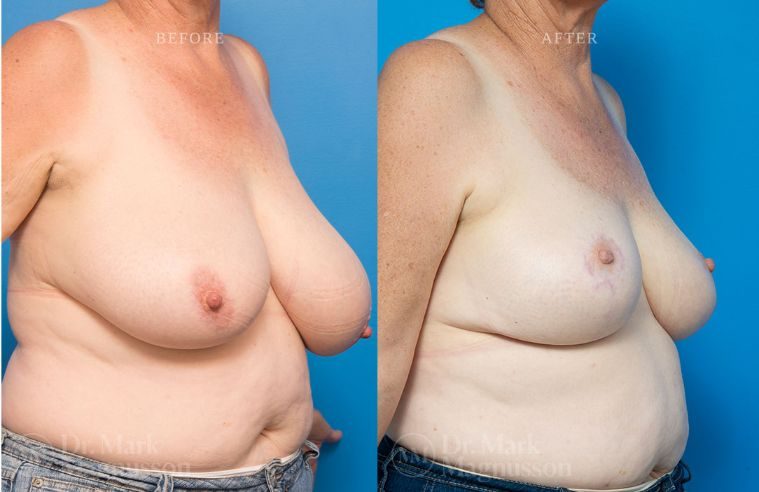 Breast Asymmetry Correction and Reduction Mammoplasty BA 010