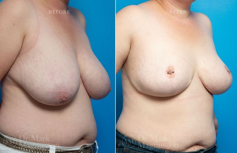 Breast Asymmetry Correction and Reduction Mammoplasty BA 012