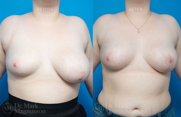 Breast Asymmetry Correction, Breast Reduction, and Breast Implants BA 001
