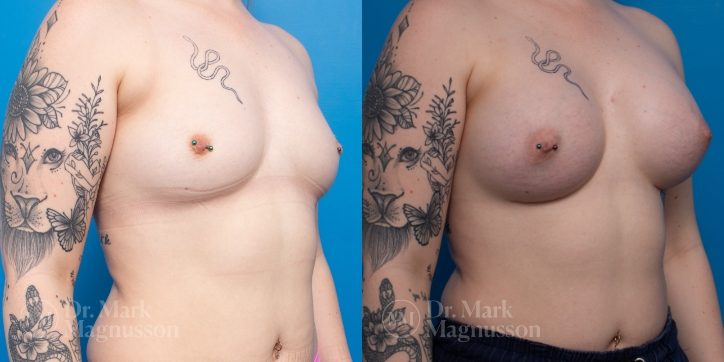 PRE Bilateral breast augmentation Motiva RSF 450 - sub muscular implant placement | POST 8 WKS Bilateral breast augmentation Motiva RSF 450 - sub muscular implant placement